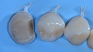 Frattura del dente - Intarsio preparazione