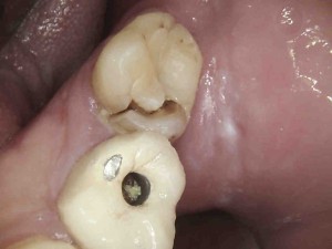 Frattura del dente - Frattura