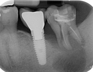 Frattura del dente - Radiografia