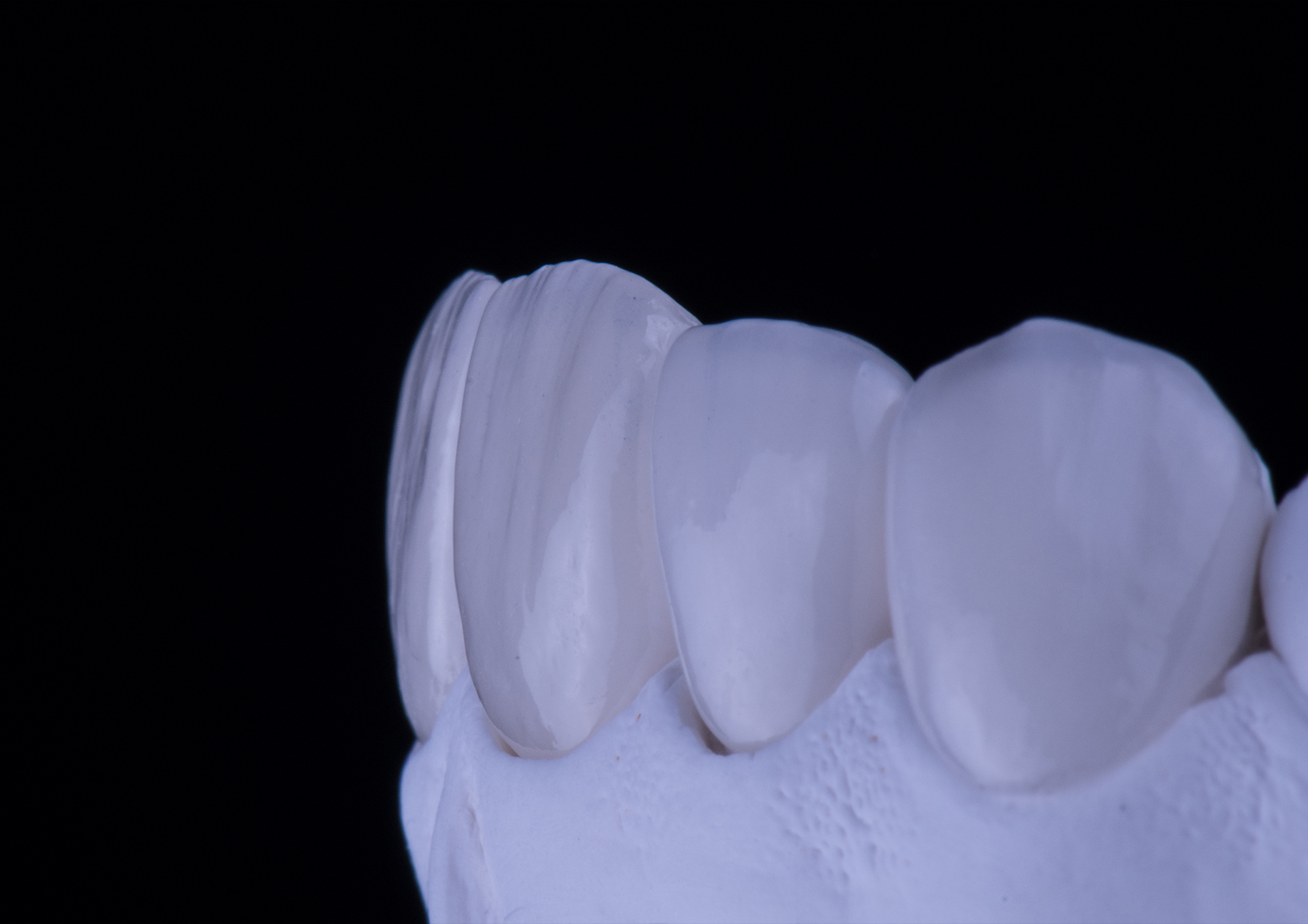 Faccette dentali in ceramica realizzate su modello in laboratorio odontotecnico, progettate digitalmente per adattarsi perfettamente ai denti naturali.